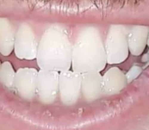 Laser teeth whitening