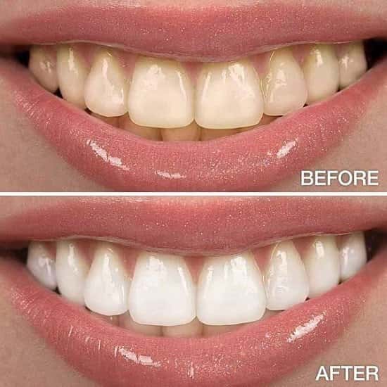 SAVE £15 - Introducing teeth whitening!