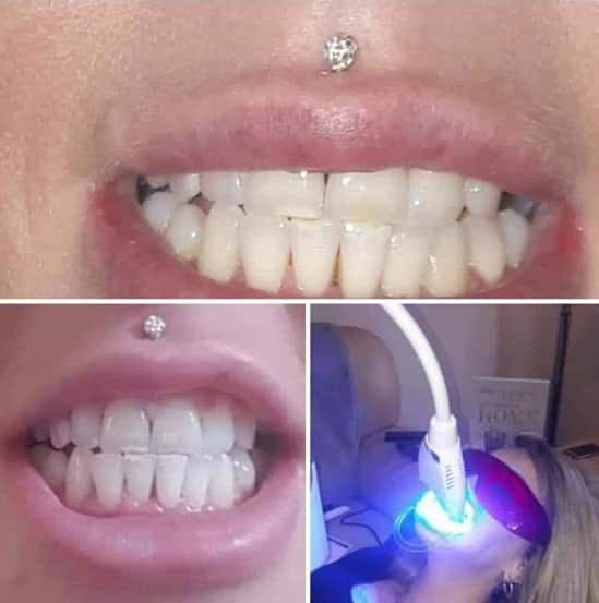 Laser teeth