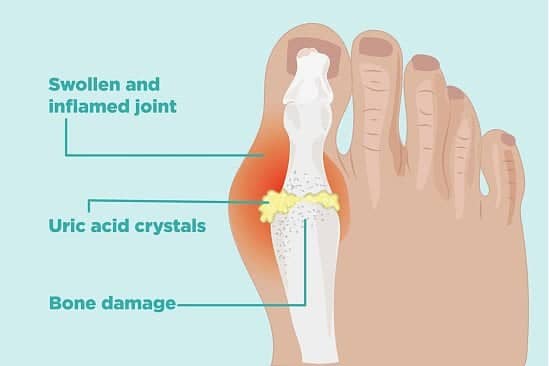 Painful Debilitating Gout in Your Joints?