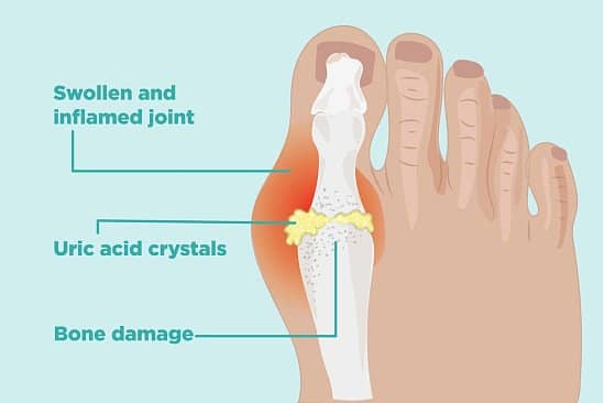 Painful Debilitating Gout in Your Joints?