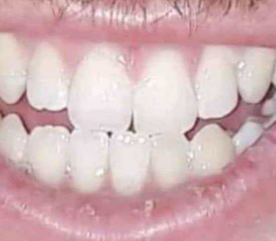 Laser teeth whitening